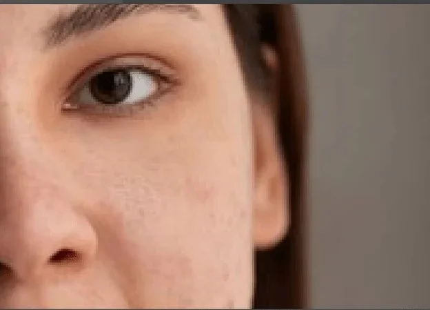 Removing Blemishes In Photoshop Final Image