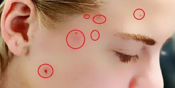 how to remove blemishes from photos before image